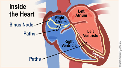 Diagram shows inside the heart, identifying the sinus node, paths, right atrium, left atrium, left ventricle, septum, and right ventricle.