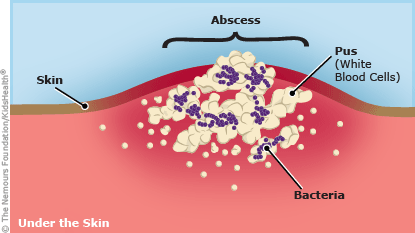 abscess illustration