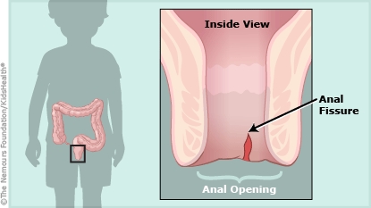 anal fissure illustration