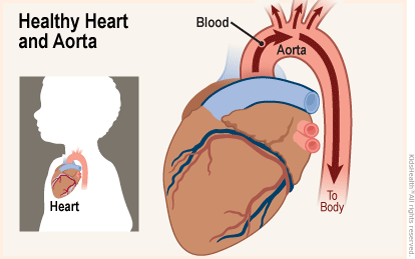 Two diagrams show the position of the heart in the body and a close-up of a healthy heart. Blood flows unrestricted from the heart through the aorta and on to the body. 