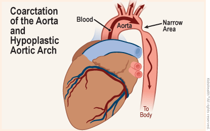 Diagram of the heart shows coartation of the aorta and hypoplastic aorta arch — when a narrow area develops in the aorta outside the heart reducing or blocking blood flow to the body.