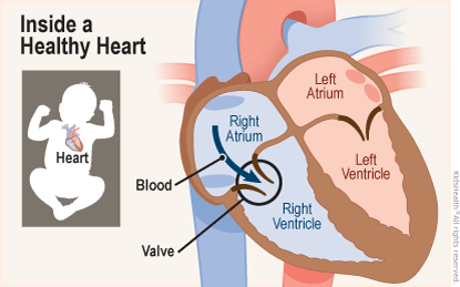 Two diagrams show the position of the heart in the body and a close-up, cross section of a healthy heart. Blood flows normally from the right atrium into the right ventricle. 