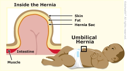 Kidshealth: Umbilical Hernias