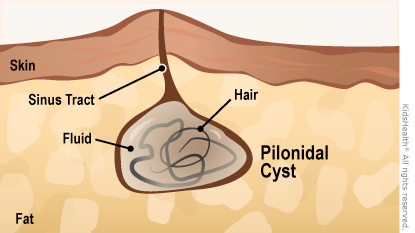 Cross section showing fluid- and hair-filled pilonidal cyst under the skin, with a sinus tract.