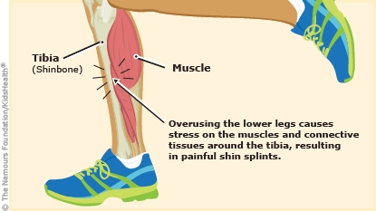 II. Understanding Shin Splints: Causes and Symptoms
