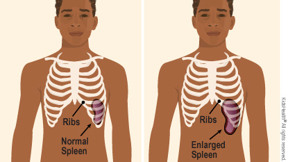 A normal spleen is fully covered by the ribs. An enlarged spleen means some of the spleen is not protected by the ribs.