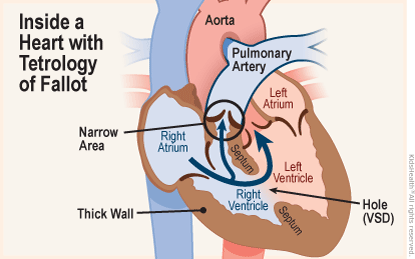 Cross section diagram of a heart shows tetrology of fallot — a critical congenital defect featuring four problems. First, a hole (VSD) in the septum between the venticles affecting proper blood flow; second, a narrowed passage from the heart to the lungs; third, the aorta lies over the hole in the ventricles; and fourth, the muscle surrounding the right ventricle becomes too thick.