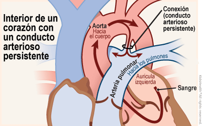 Se muestra el corazón con un conducto arterioso permeable: una conexión entre la aorta y la arteria pulmonar que sale del corazón. La conexión es una parte normal del sistema circulatorio de un bebé en el útero, sin embargo, generalmente se cierra poco después del nacimiento.