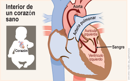 Se muestran dos ilustraciones. Una muestra la posición del corazón en el cuerpo y la otra un primer plano de un corte transversal de un corazón sano. La sangre fluye desde la aurícula izquierda hacia el ventrículo izquierdo y, a través de una válvula, llega a la aorta. 