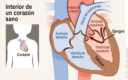 Se muestran dos ilustraciones. Una muestra la posición del corazón en el cuerpo y la otra un corte transversal de un corazón sano. La sangre fluye desde la aurícula izquierda hacia el ventrículo izquierdo y, a través de una válvula, llega a la aorta. 