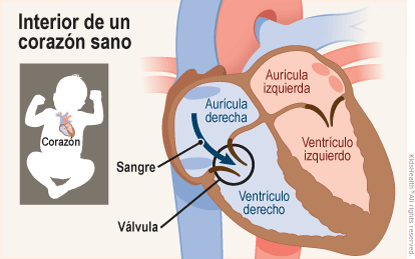 Se muestran dos ilustraciones. Una muestra la posición del corazón en el cuerpo y la otra un corte transversal de un corazón sano. La sangre fluye normalmente desde la aurícula derecha hacia el ventrículo derecho. 
