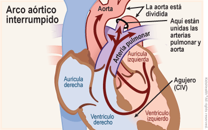 Se muestra un corte transversal del corazón con un arco aórtico interrumpido: un defecto congénito donde se divide la aorta, la parte superior es normal, pero debajo se unen la aorta y la arteria pulmonar. Un poco de sangre fluye normalmente de la aurícula izquierda al ventrículo izquierdo para luego dirigirse hacia la aorta. Pero un orificio en el tabique que separa los dos ventrículos permite que la sangre fluya directamente del ventrículo izquierdo al derecho.