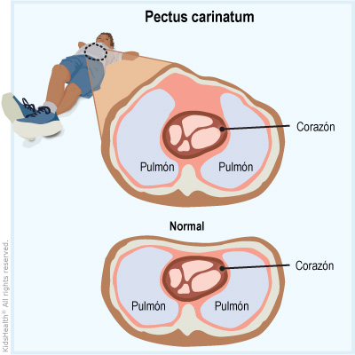 El pectus carinatum que muestra el corazón y los pulmones dentro de la caja torácica.