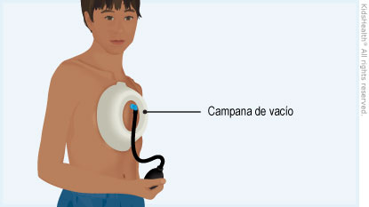 Illustration: Vacuum Bell Device