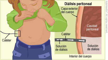 Diálisis peritoneal: se muestra un catéter que administra una solución de diálisis a través de las capas externas del cuerpo hasta la cavidad peritoneal en el interior del cuerpo.