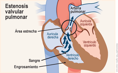 Se muestra un corte transversal de un corazón con estenosis valvular pulmonar, donde la válvula entre el ventrículo derecho y la arteria pulmonar es demasiado estrecha y restringe el flujo sanguíneo. En algunos casos, esta afección produce un engrosamiento de los músculos del ventrículo.