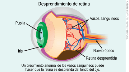 ilustracion desprendimiento de retina
